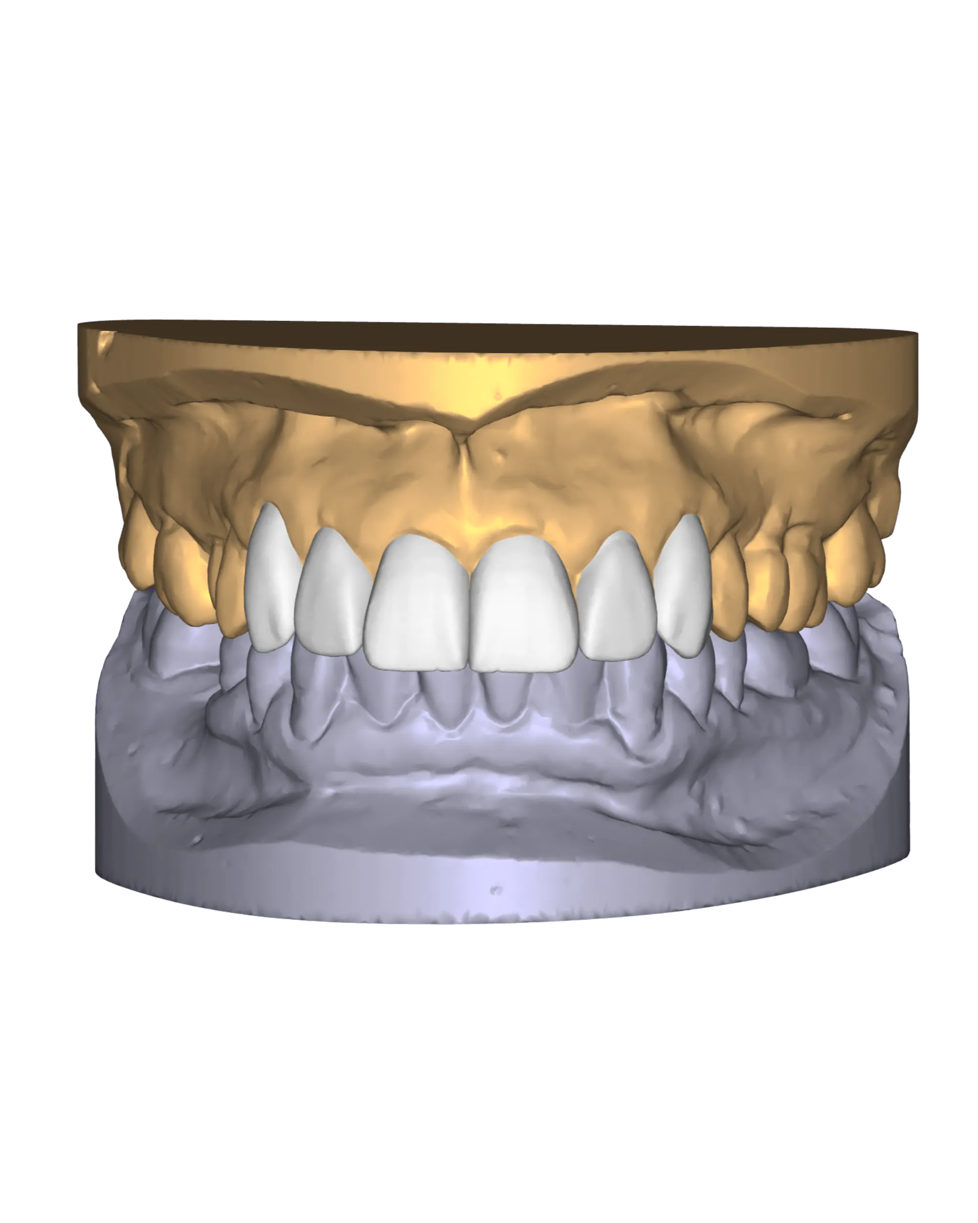 Digital diagnostic wax-up designed over the patient's existing teeth, shown between the upper and lower arches