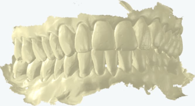 Intraoral bite scan showing the upper and lower arches captured together in occlusion, viewed from the buccal (cheek) side