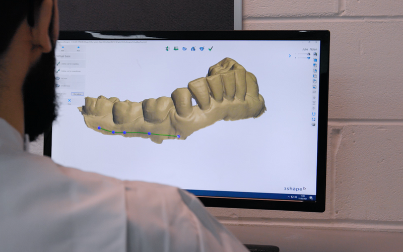 Aligner treatment shown on computer screen