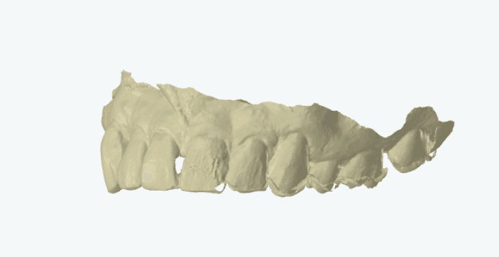 Intraoral scan with smearing and distortion