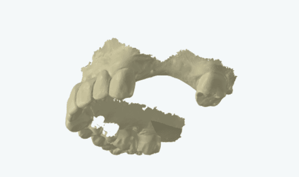 Intraoral scan with holes and missing data