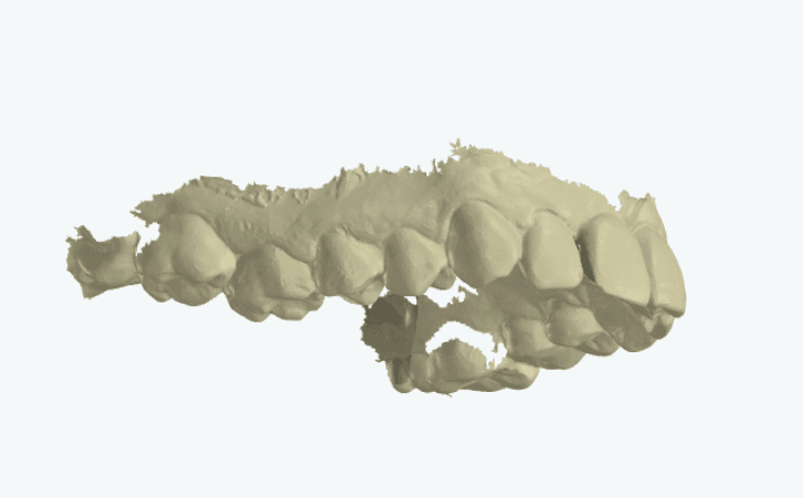 Intraoral scan with ragged soft-tissue noise